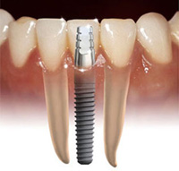 implants