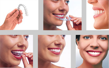invisalign