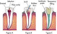 rootcanal