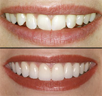veneers