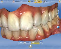 cerec crowns