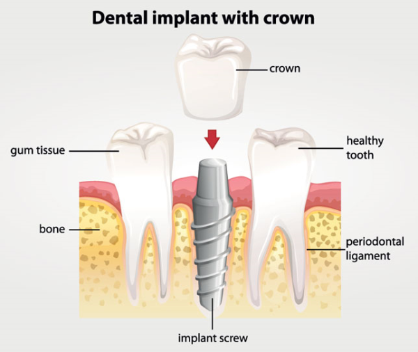 dental implant resized 600