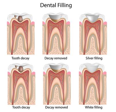 dental_filling