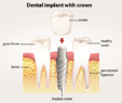 dental implant