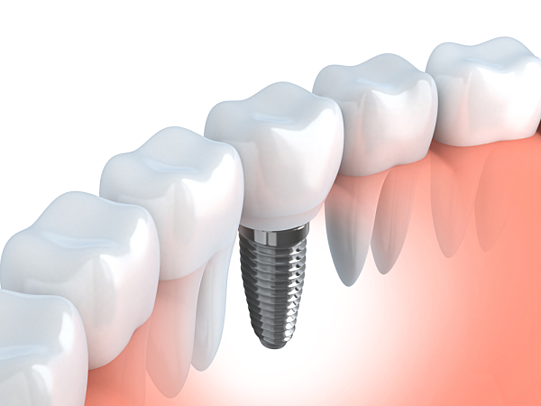 Dental Implant