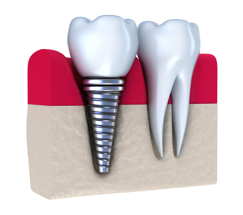 dental implant