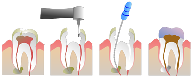 Root Canal, Foxboro