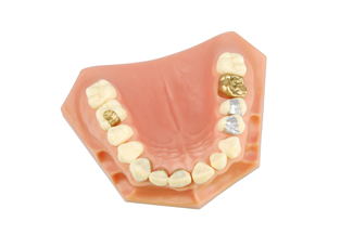 tooth filling types resized 600