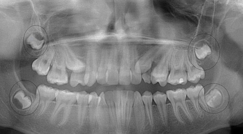 Wisodom teeth panoramic xray